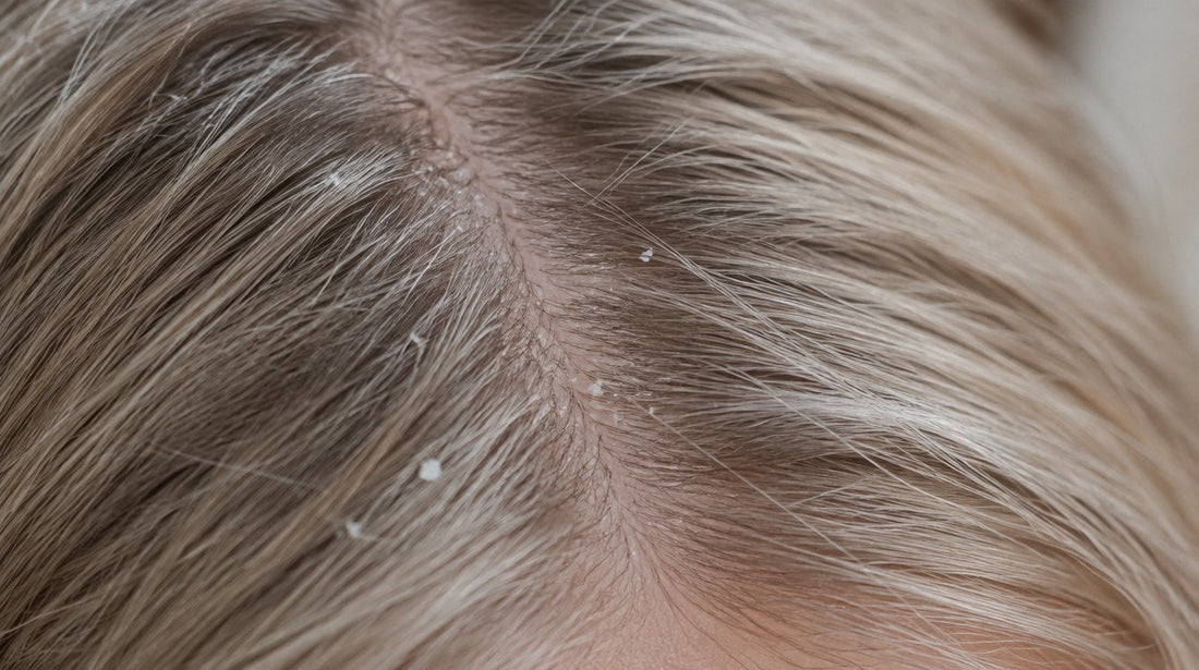 Close-up of a hair part with small white flakes visible near the roots