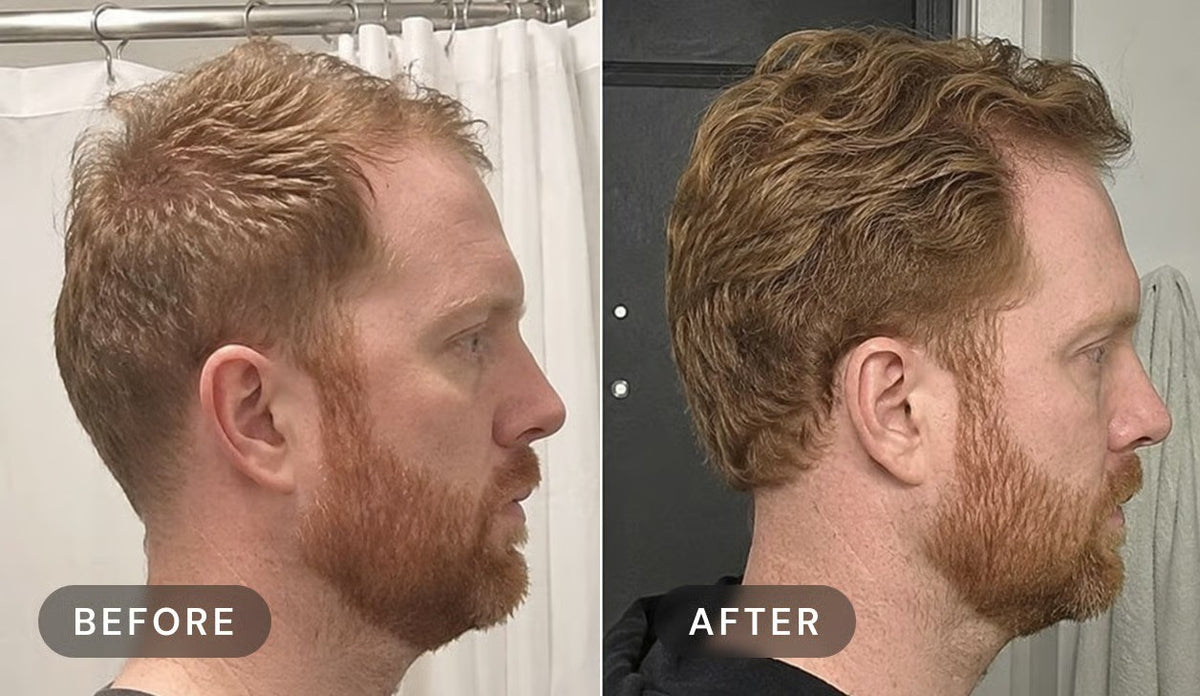 Manufacturer's user trial, before and after: side view of a red-haired man's receding hairline