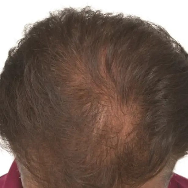 Thinner hair at the crown
