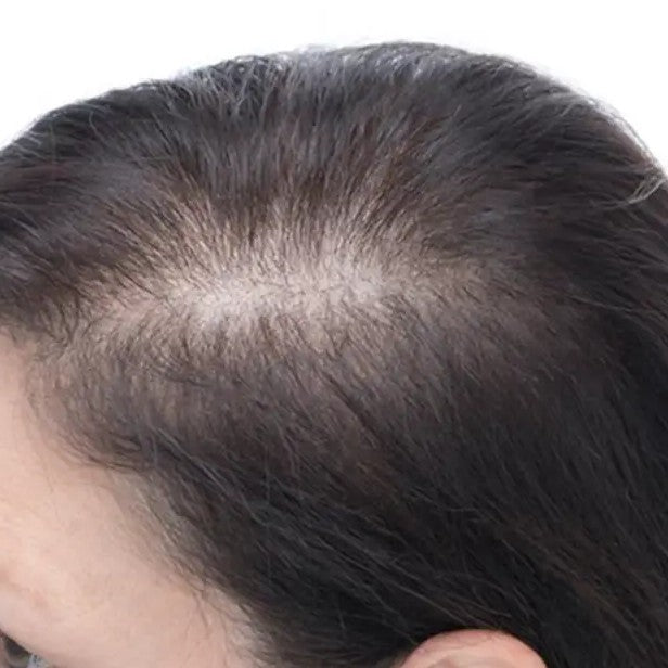 Hairline thinning at the temple