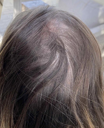 Scalp before starting, week one