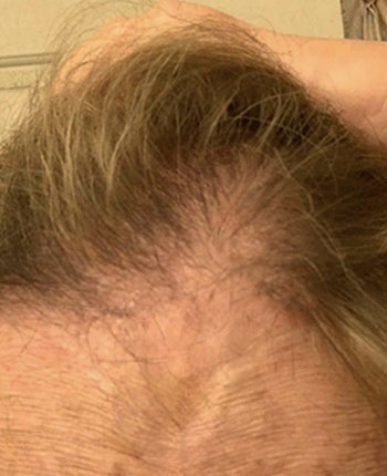 Scalp before starting, week one