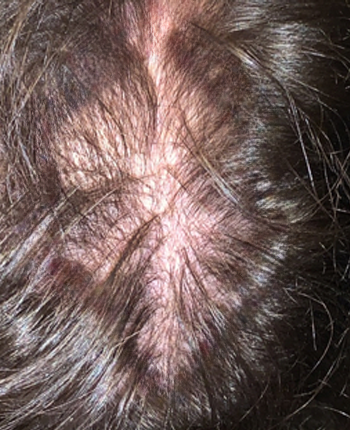 Scalp before starting, week one