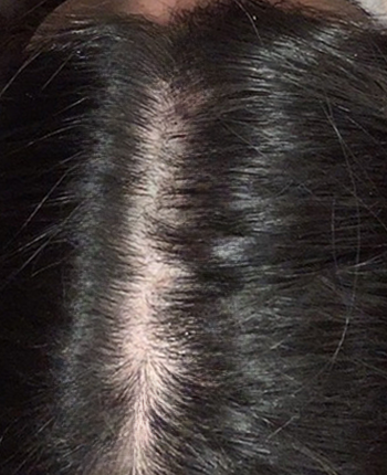 Scalp before starting, week one