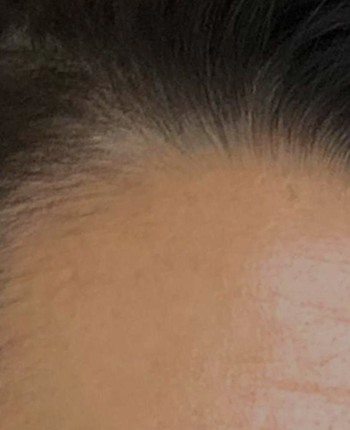 Scalp before starting, week one