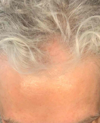 Scalp before starting, week one