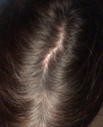 Scalp before starting, week one