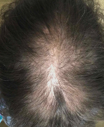 Scalp before starting, week one