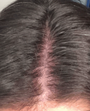 Scalp before starting, week one