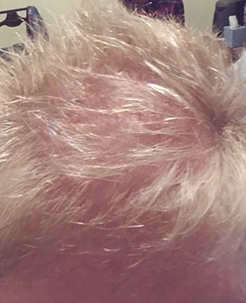 Scalp before starting, week one