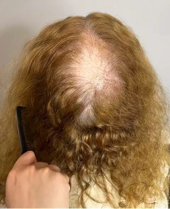 Scalp before starting, week one