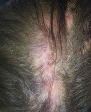 Scalp before starting, week one