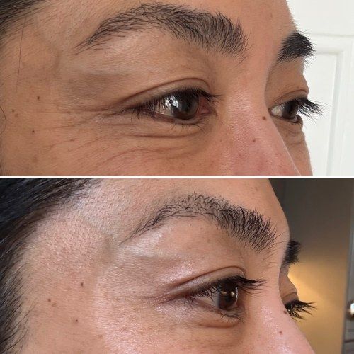 The area around the eyes before and after weeks of LED face mask sessions