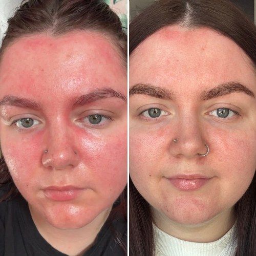 Evenness of skin tone before and after weeks of LED face mask sessions