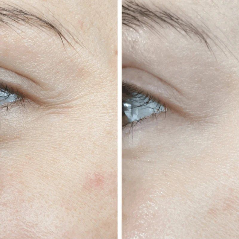 Fine lines by the eyes before and after weeks of LED face mask sessions