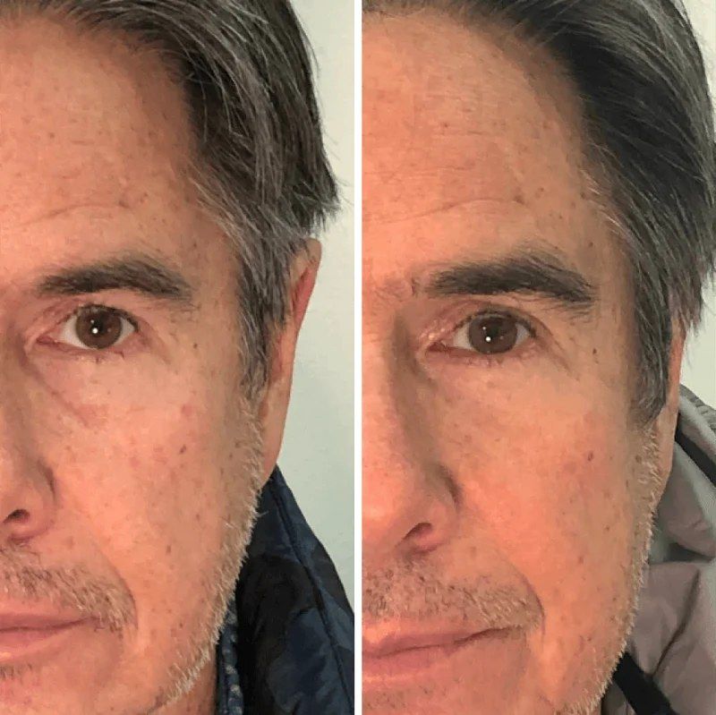 Forehead and eyes before and after weeks of LED face mask sessions