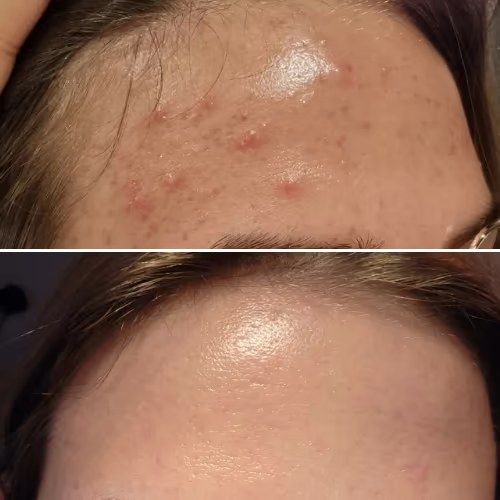 Forehead texture before and after weeks of LED face mask sessions