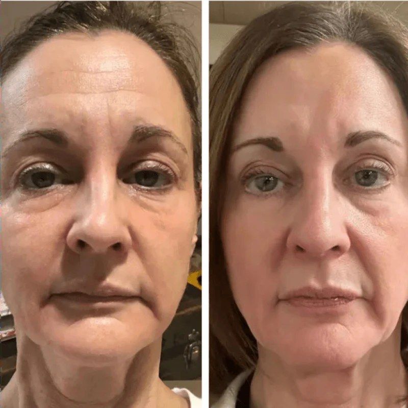 A woman's full face before and after weeks of sessions with this LED face mask model, same light