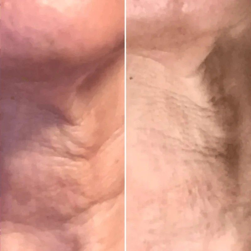 Neck before and after weeks of LED face mask sessions