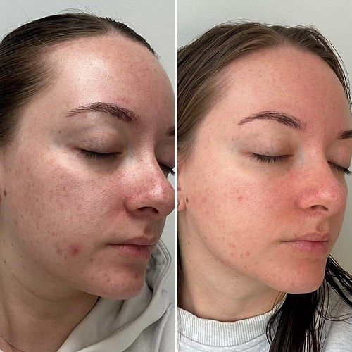 Skin texture before and after weeks of LED face mask sessions